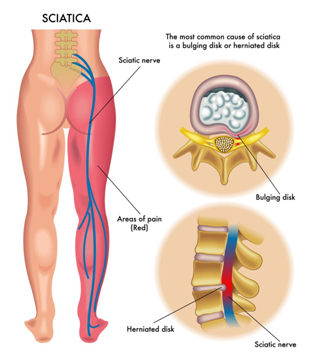 Sciatica - Integrate Physio