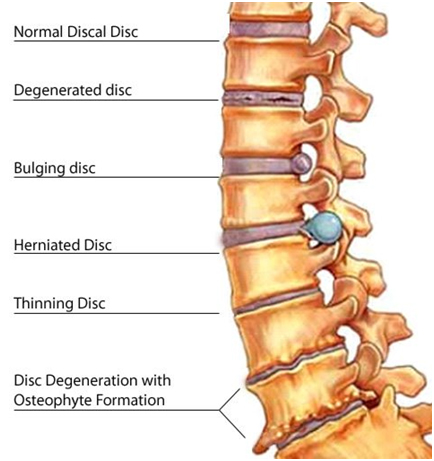 All About Sciatica From a Herniated Disc