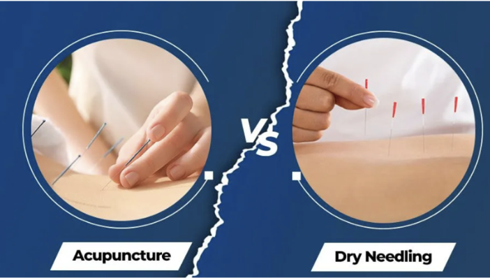Dry Needling vs Acupuncture - Physio